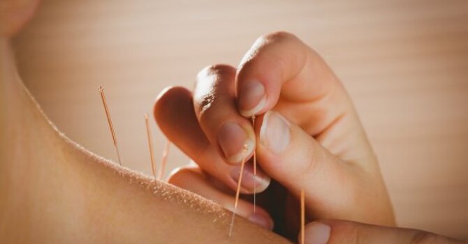 Acupuncture & Cupping