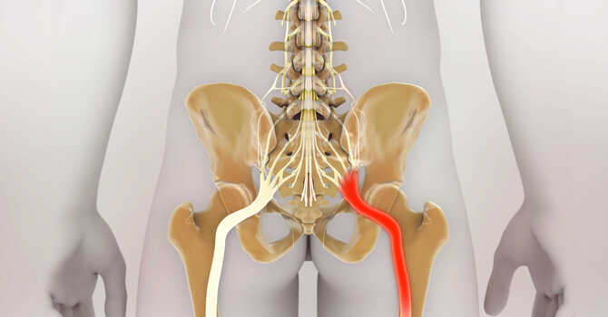 Sciatica image
